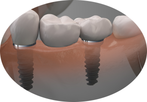 Algodones Dental Clinic with titanium Implants