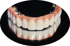Algodones Dental Clinic with high quality dentures